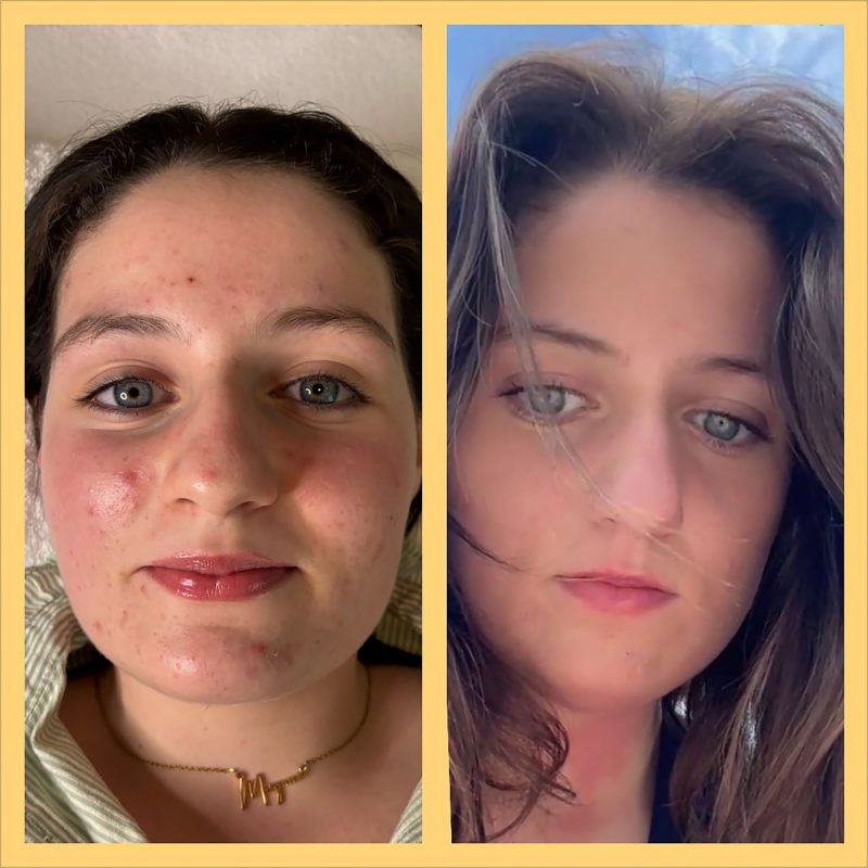 na 1 behandeling voor “acne”