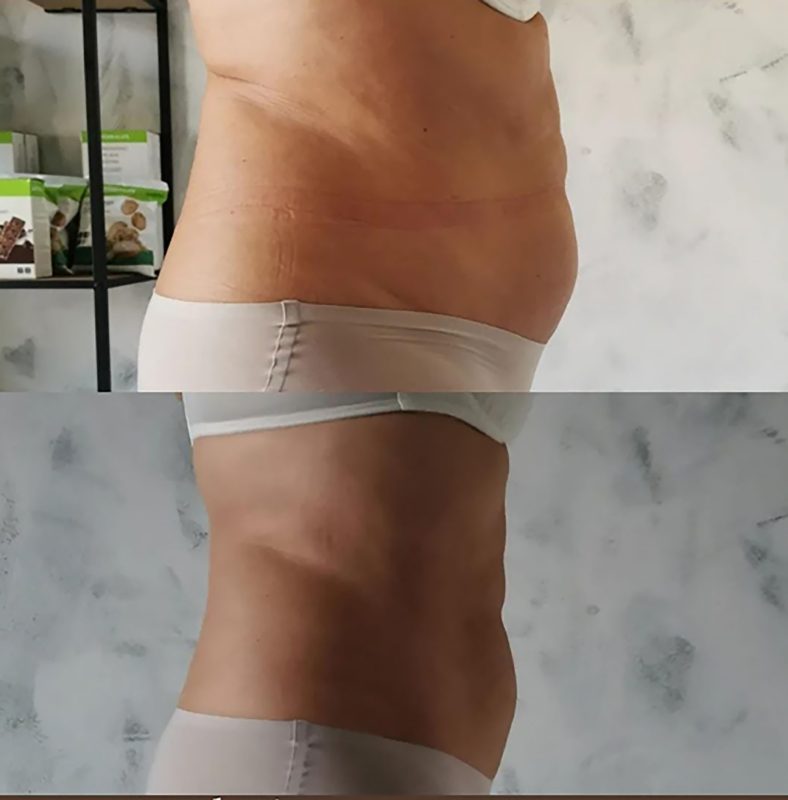 voor en na 1 kuur slimyonik